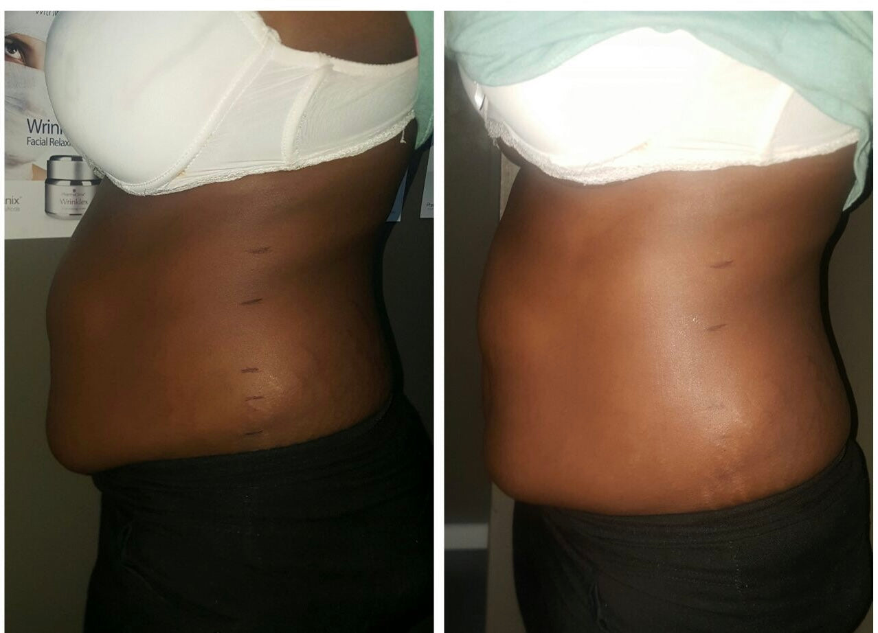 Computerized Slimming Machines