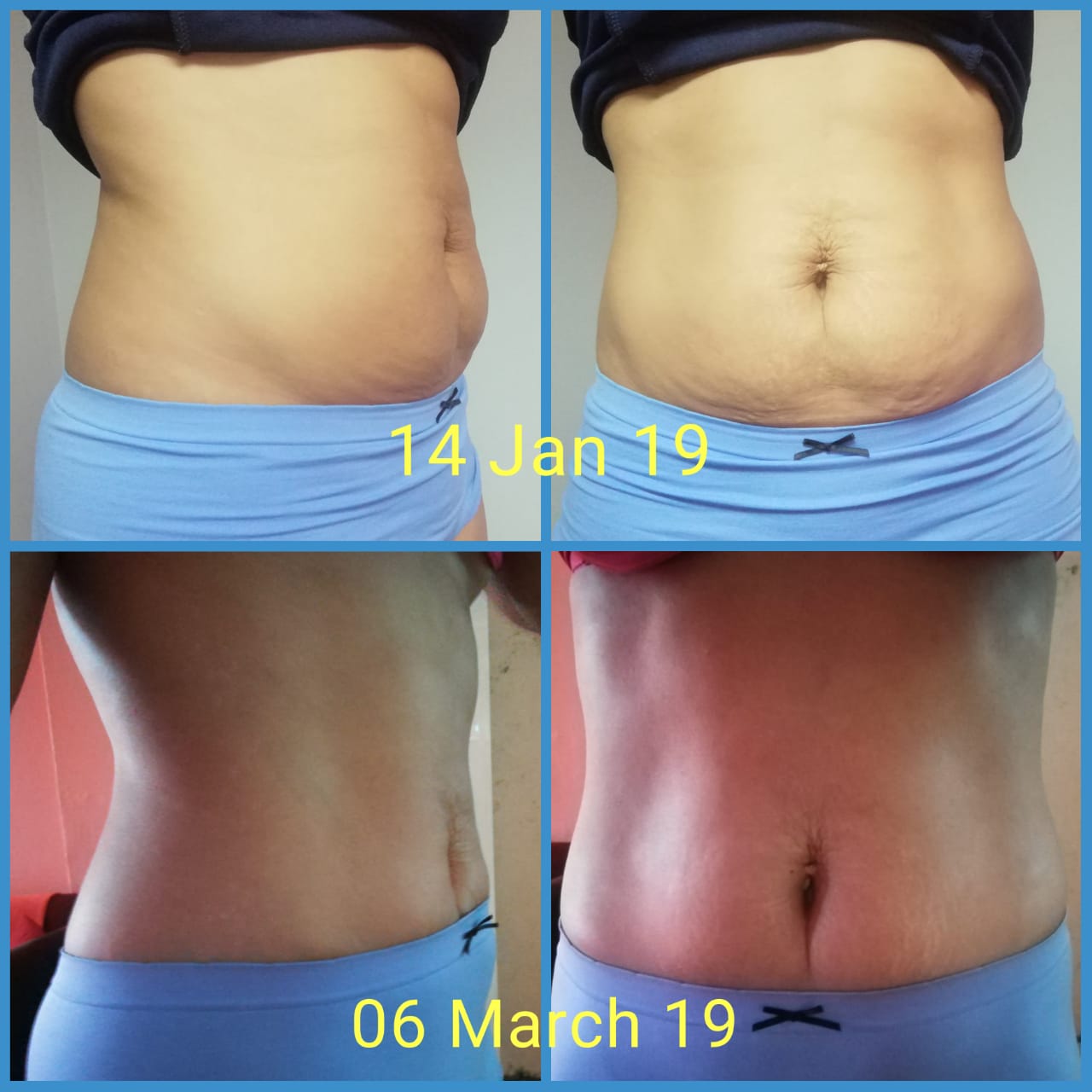 Computerized Slimming Machines