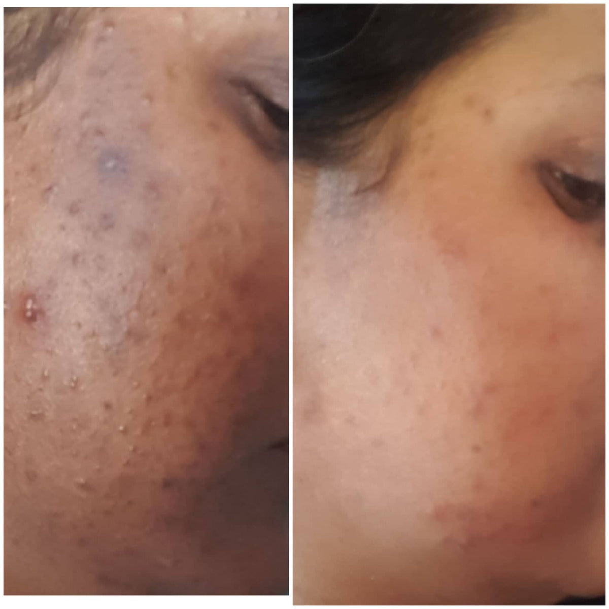 Skin Corrector Trifecta: Upgraded