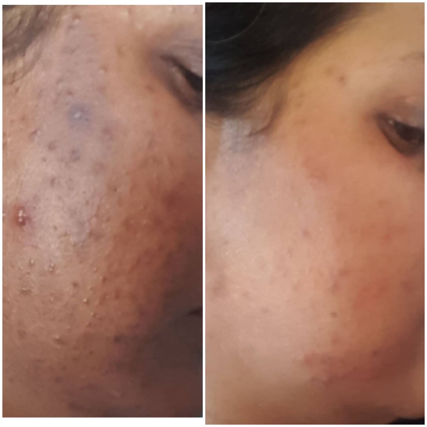 Pigmentation Corrector/Melanin Blocker
